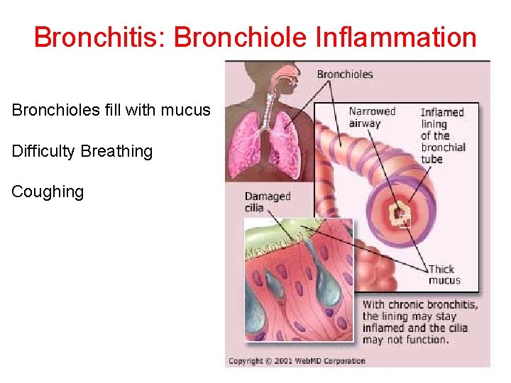 Bronchitis: Bronchiole Inflammation Bronchioles fill with mucus Difficulty Breathing Coughing 
