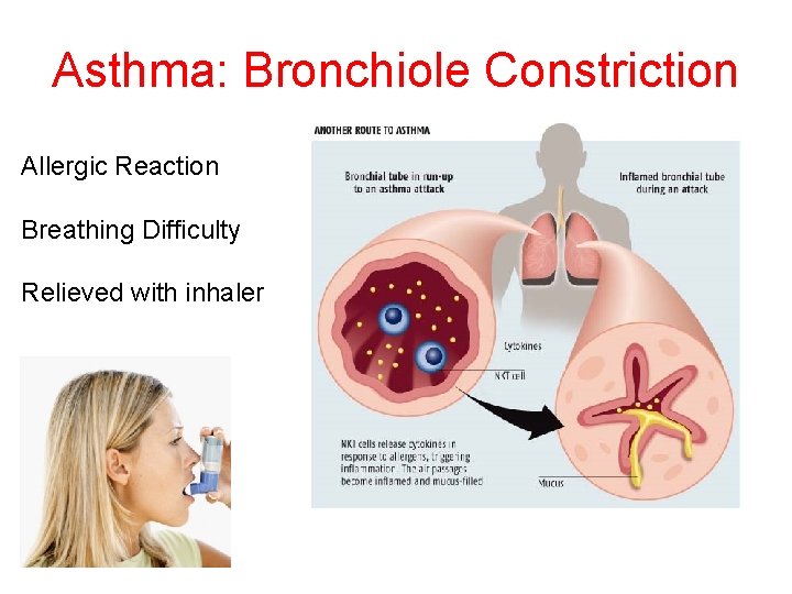 Asthma: Bronchiole Constriction Allergic Reaction Breathing Difficulty Relieved with inhaler 