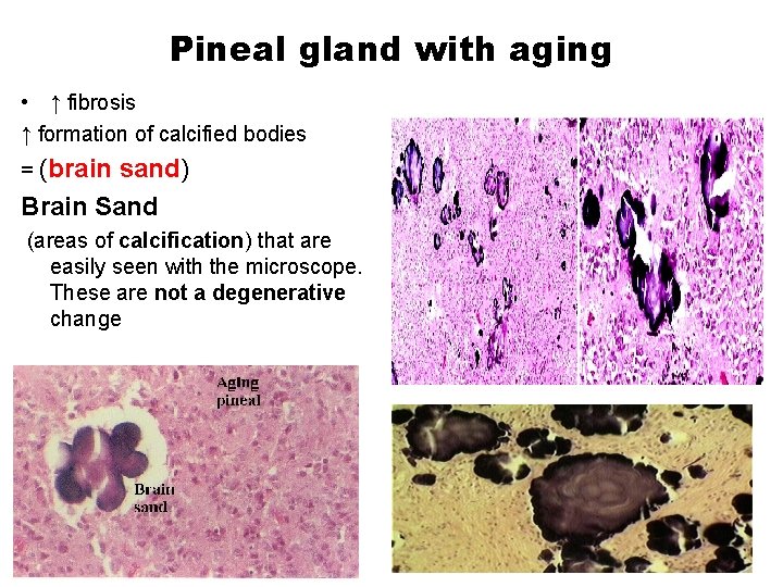 Pineal gland with aging • ↑ fibrosis ↑ formation of calcified bodies = (brain
