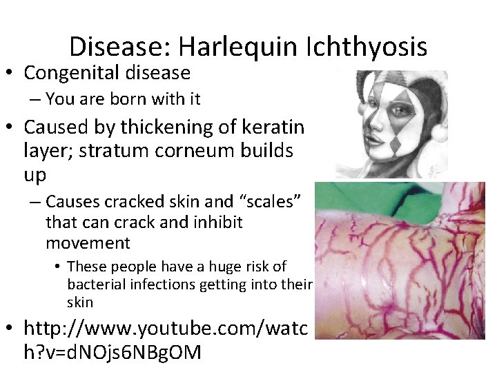 Disease: Harlequin Ichthyosis • Congenital disease – You are born with it • Caused