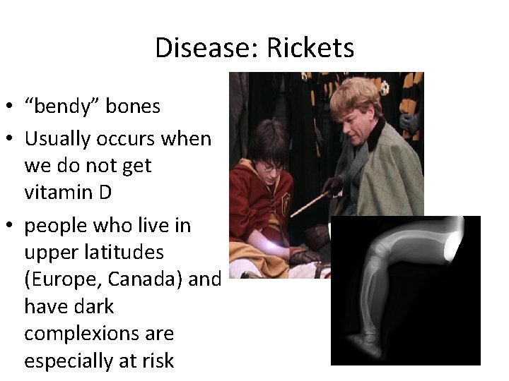 Disease: Rickets • “bendy” bones • Usually occurs when we do not get vitamin