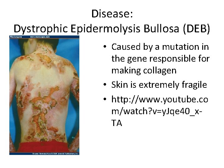 Disease: Dystrophic Epidermolysis Bullosa (DEB) • Caused by a mutation in the gene responsible