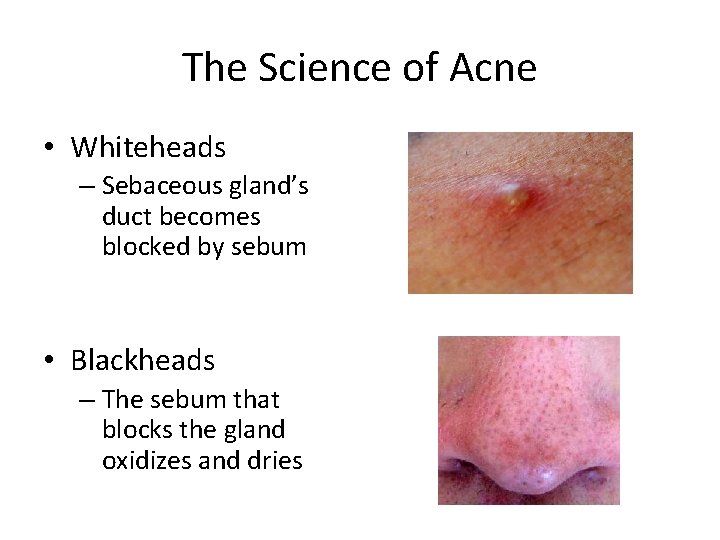 The Science of Acne • Whiteheads – Sebaceous gland’s duct becomes blocked by sebum