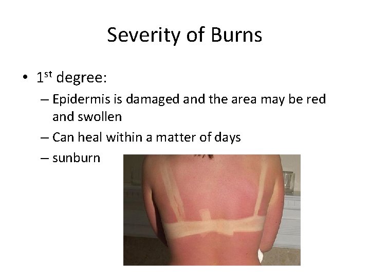 Severity of Burns • 1 st degree: – Epidermis is damaged and the area