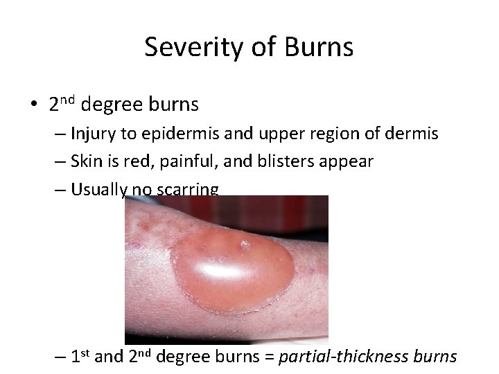 Severity of Burns • 2 nd degree burns – Injury to epidermis and upper