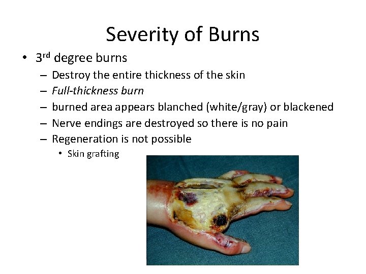 Severity of Burns • 3 rd degree burns – – – Destroy the entire