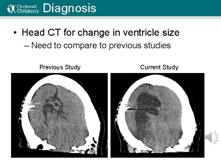 Diagnosis • Head CT for change in ventricle size – Need to compare to