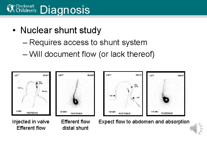 Diagnosis • Nuclear shunt study – Requires access to shunt system – Will document