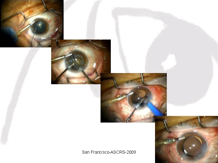 San Francisco-ASCRS-2009 