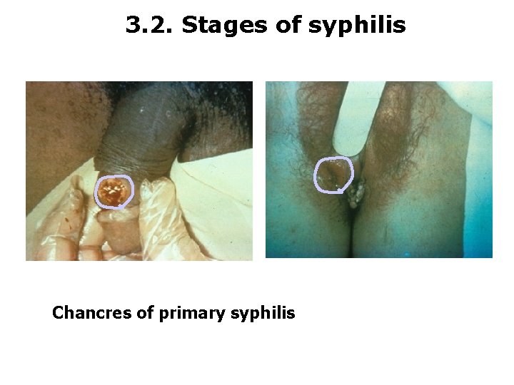 3. 2. Stages of syphilis Chancres of primary syphilis 