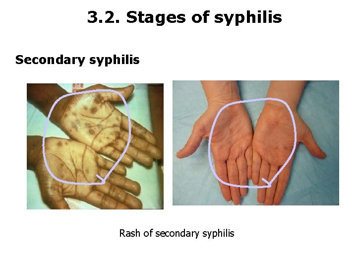 3. 2. Stages of syphilis Secondary syphilis Rash of secondary syphilis 
