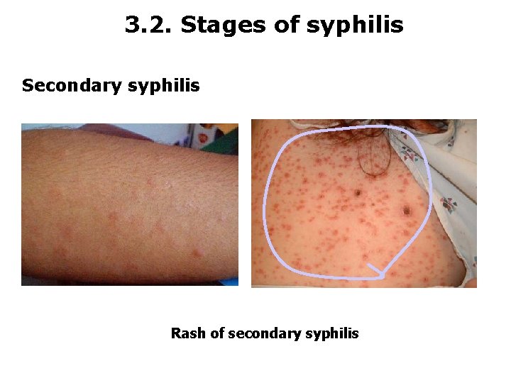 3. 2. Stages of syphilis Secondary syphilis Rash of secondary syphilis 