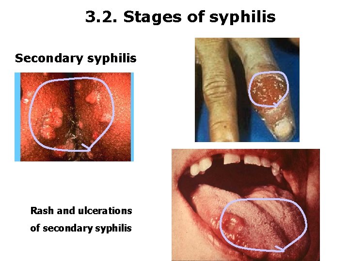 3. 2. Stages of syphilis Secondary syphilis Rash and ulcerations of secondary syphilis 