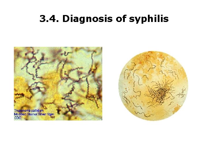 3. 4. Diagnosis of syphilis 