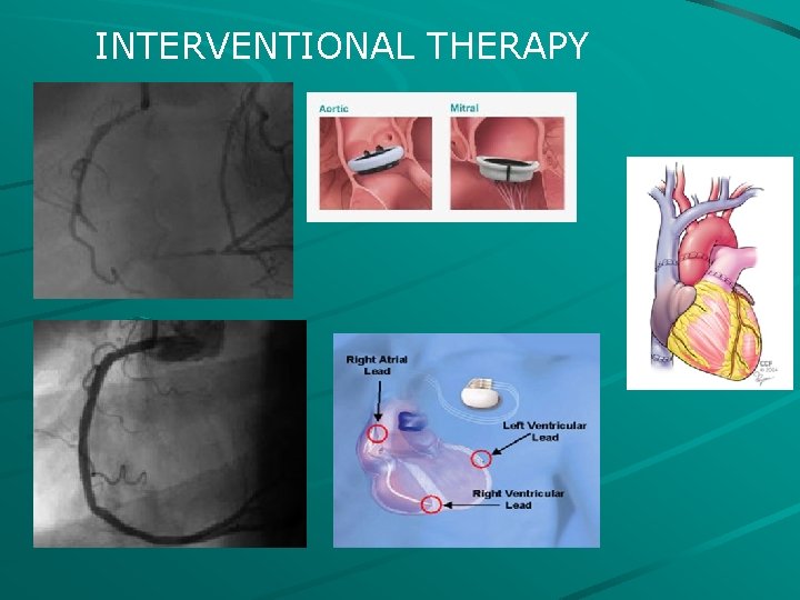 Image showcasing Cardiac Rehabilitation Class I A Recommendation For A