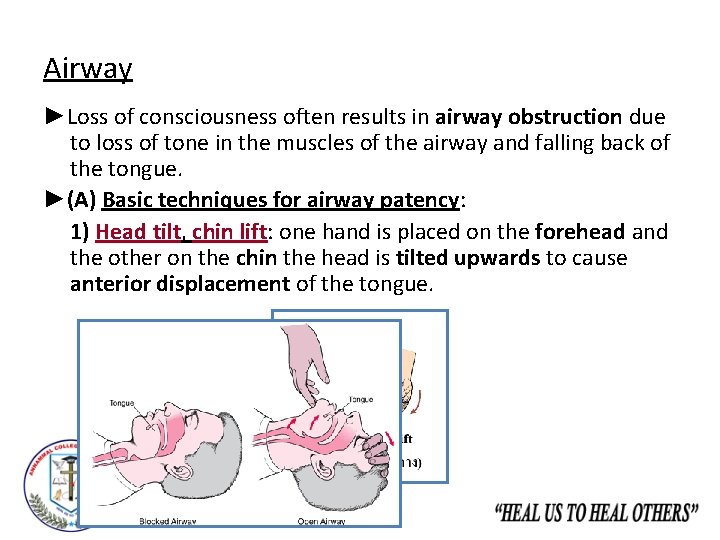 Airway ►Loss of consciousness often results in airway obstruction due to loss of tone