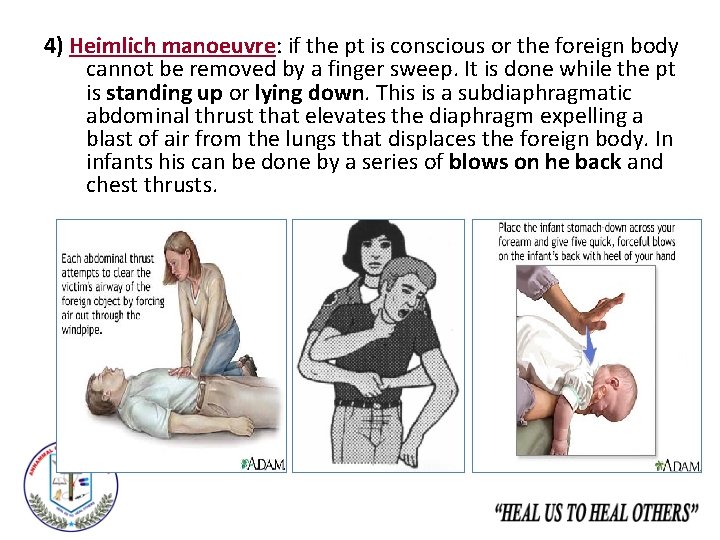 4) Heimlich manoeuvre: if the pt is conscious or the foreign body cannot be