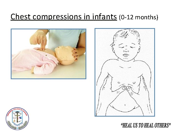 Chest compressions in infants (0 -12 months) 