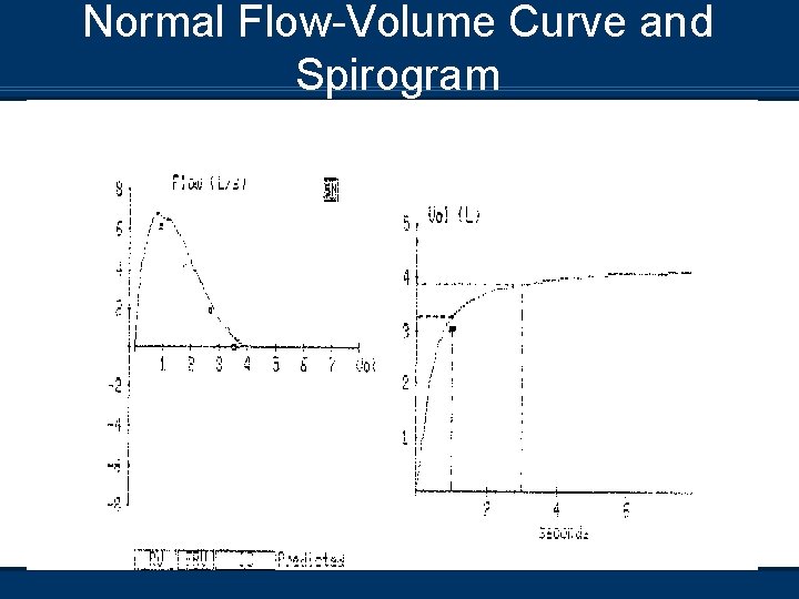 Normal Flow-Volume Curve and Spirogram 