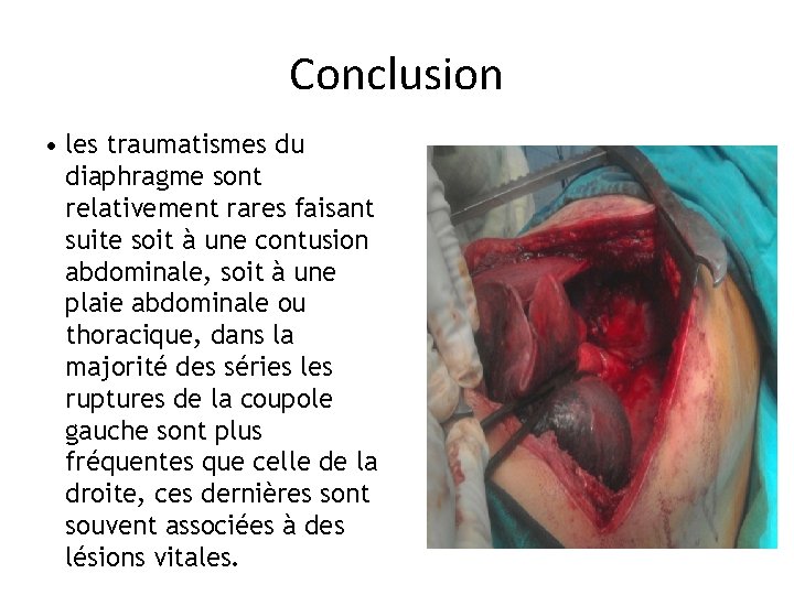 Conclusion • les traumatismes du diaphragme sont relativement rares faisant suite soit à une