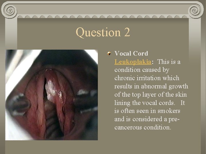 Question 2 Vocal Cord Leukoplakia: This is a condition caused by chronic irritation which