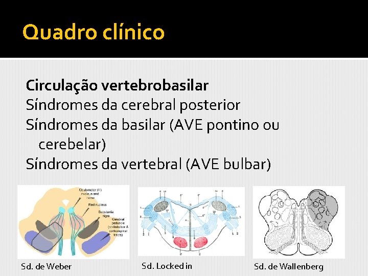 Quadro clínico Circulação vertebrobasilar Síndromes da cerebral posterior Síndromes da basilar (AVE pontino ou