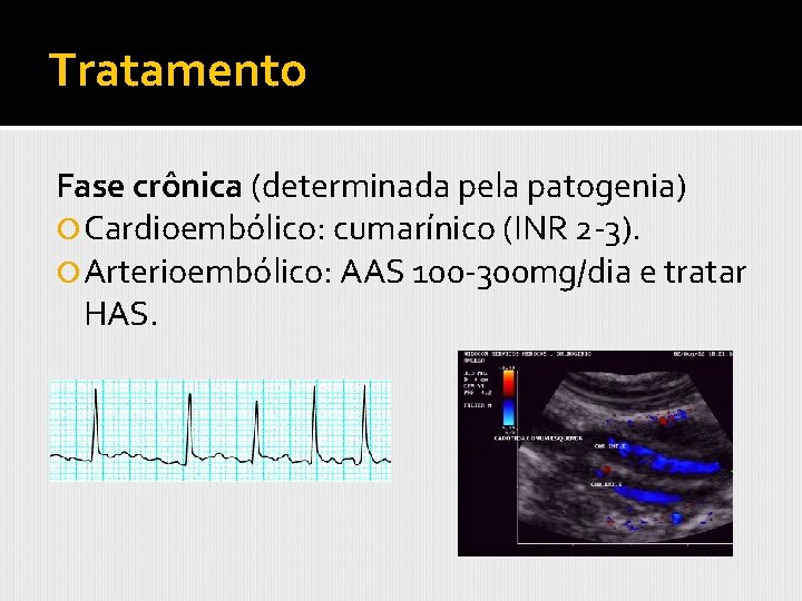 Tratamento Fase crônica (determinada pela patogenia) Cardioembólico: cumarínico (INR 2 -3). Arterioembólico: AAS 100