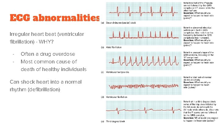 ECG abnormalities Irregular heart beat (ventricular fibrillation) - WHY? - Often a drug overdose