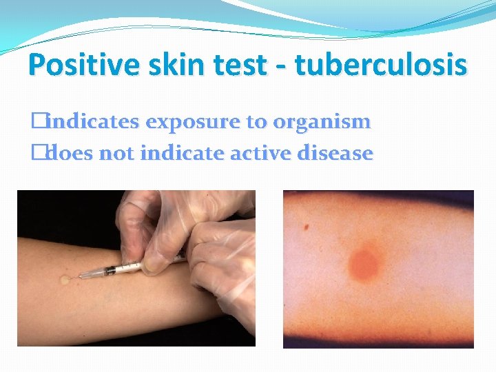 Positive skin test - tuberculosis �indicates exposure to organism �does not indicate active disease