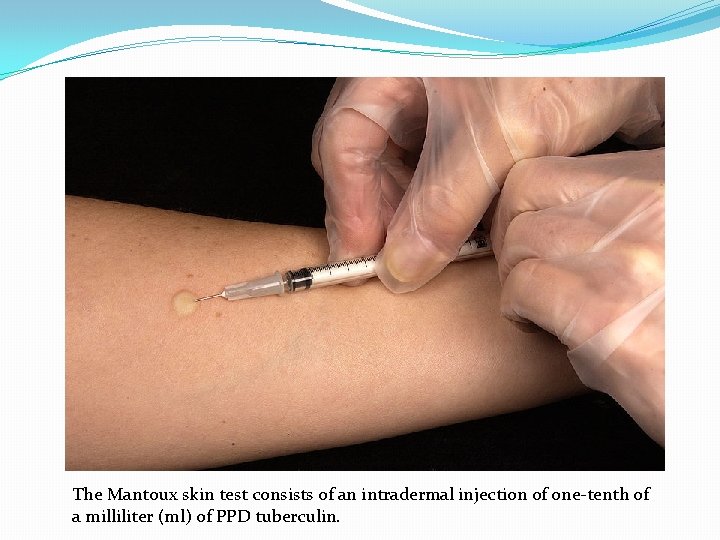The Mantoux skin test consists of an intradermal injection of one-tenth of a milliliter