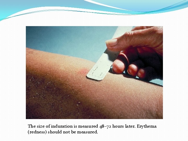The size of induration is measured 48– 72 hours later. Erythema (redness) should not