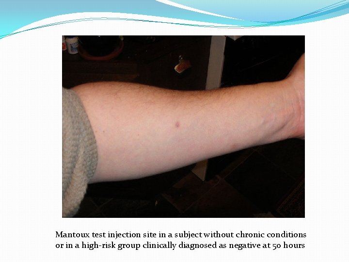 Mantoux test injection site in a subject without chronic conditions or in a high-risk