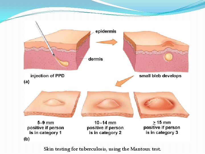 Skin testing for tuberculosis, using the Mantoux test. 