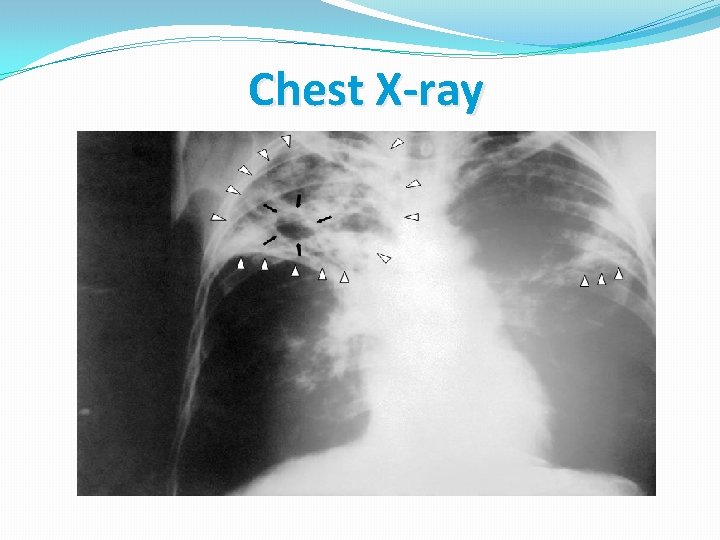 Chest X-ray 