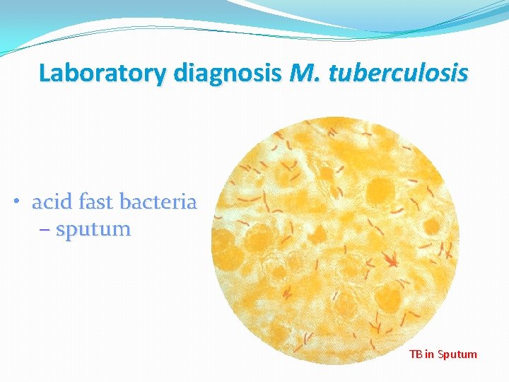Laboratory diagnosis M. tuberculosis • acid fast bacteria – sputum TB in Sputum 