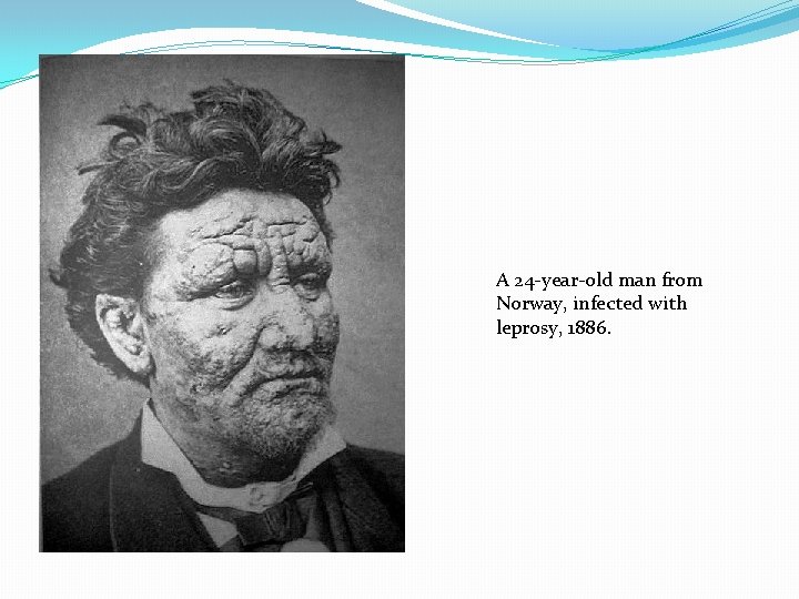 A 24 -year-old man from Norway, infected with leprosy, 1886. 