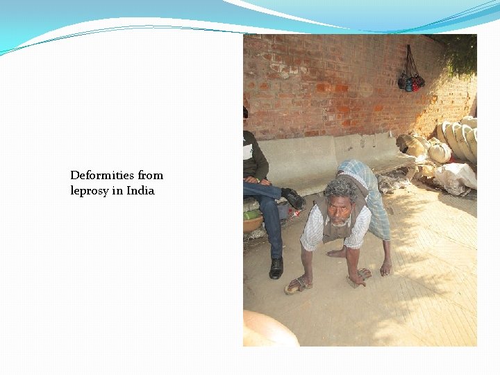 Deformities from leprosy in India 