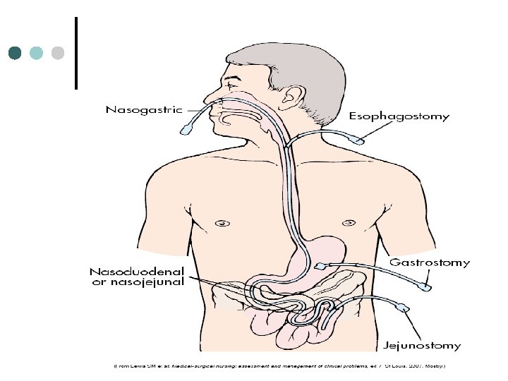 Administering Medication Through Tubes Module F Nasogastric or
