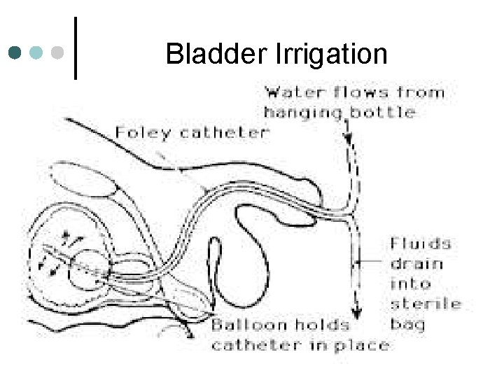 Bladder Irrigation 