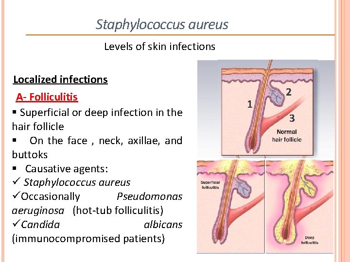 Staphylococcus aureus Levels of skin infections Localized infections A- Folliculitis § Superficial or deep