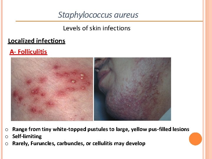 Staphylococcus aureus Levels of skin infections Localized infections A- Folliculitis o Range from tiny