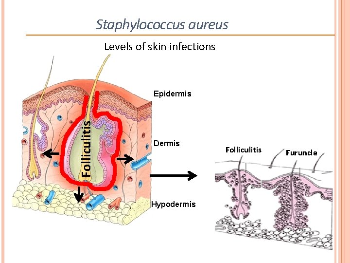 Staphylococcus aureus Levels of skin infections Folliculitis Epidermis Dermis Hypodermis Folliculitis Furuncle 