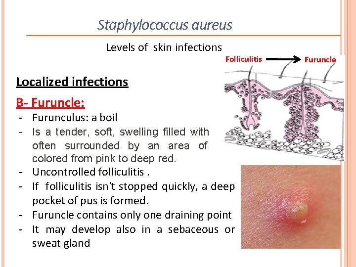 Staphylococcus aureus Levels of skin infections Folliculitis Localized infections B- Furuncle: - Furunculus: a