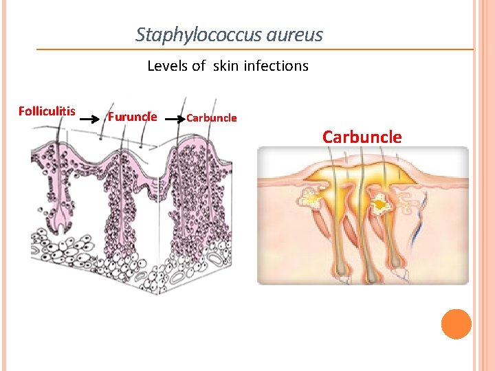 Staphylococcus aureus Levels of skin infections Folliculitis Furuncle Carbuncle 