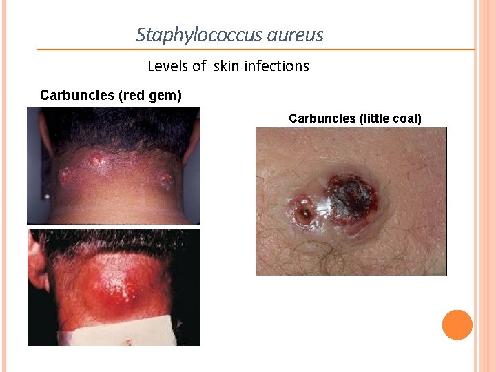 Staphylococcus aureus Levels of skin infections Carbuncles (red gem) Carbuncles (little coal) 