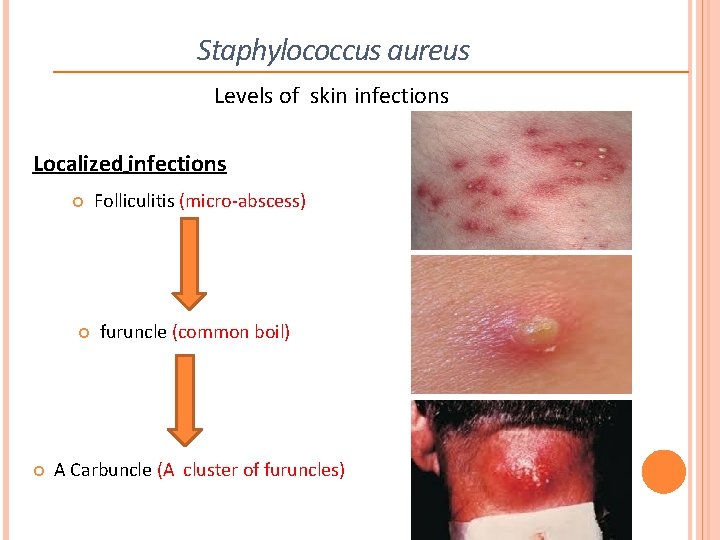 Staphylococcus aureus Levels of skin infections Localized infections Folliculitis (micro-abscess) furuncle (common boil) A