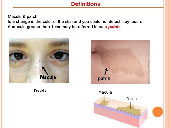 Definitions Macule & patch Is a change in the color of the skin and