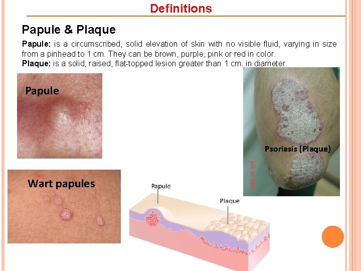 Definitions Papule & Plaque Papule: is a circumscribed, solid elevation of skin with no