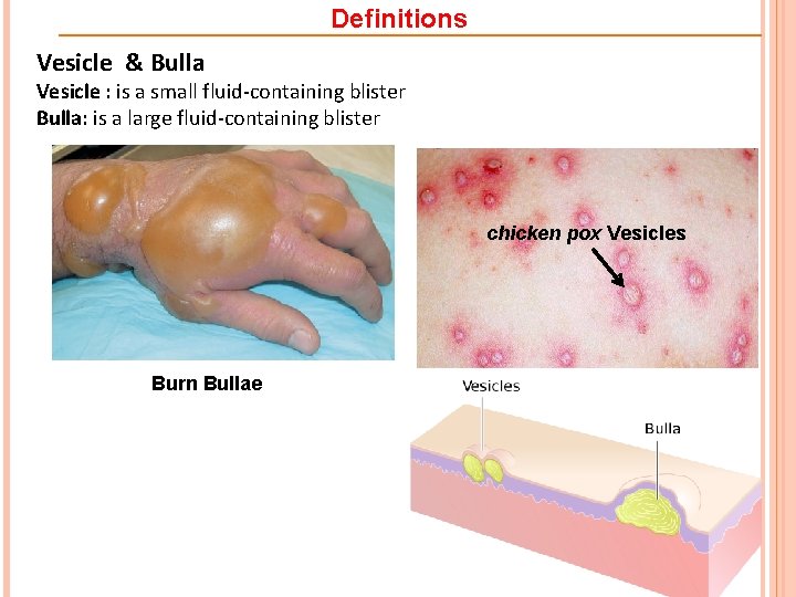 Definitions Vesicle & Bulla Vesicle : is a small fluid-containing blister Bulla: is a