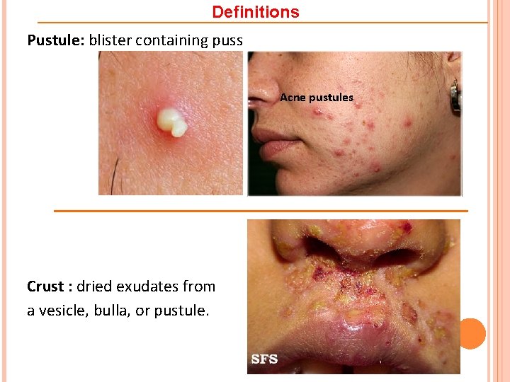 Definitions Pustule: blister containing puss Acne pustules Crust : dried exudates from a vesicle,
